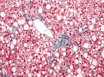 Imagen: Microfotografía de la enfermedad hepática grasa no alcohólica (Fotografía de Nephron).